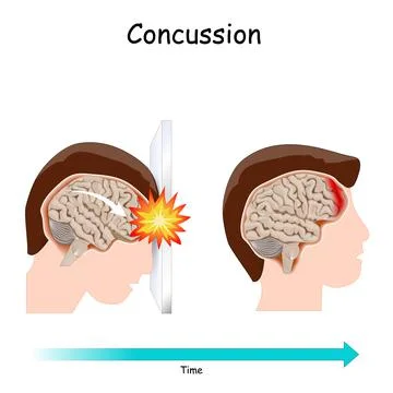 Concussion. brain  after head trauma. Illustration