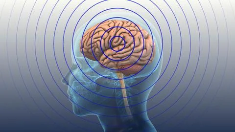 Concussion Effect On Human Brain Activity Stock Illustration