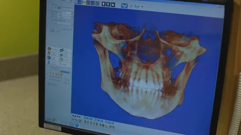 Cone Beam Scan Stock Footage 70997531