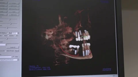 Cone beam skeletal scan Stock Footage 79277767