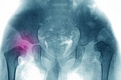  CONGENITAL HIP DISLOCATION Congential dislocation of the right hip in a 2... Stock Photos