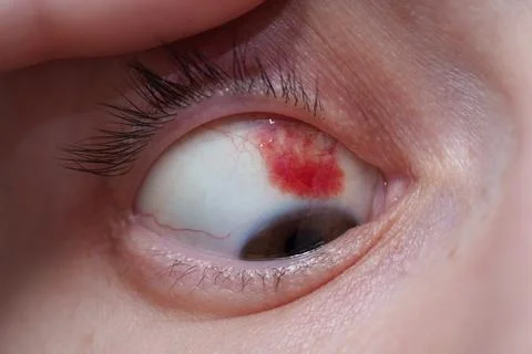 Conjunctiva. Stockfoto's
