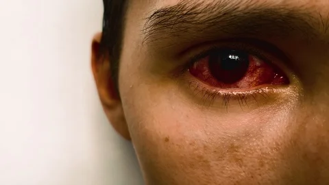 Conjunctivitis red eye. Close up of an irritated red bloodshot eye.  Stockbeeldmateriaal 112020932