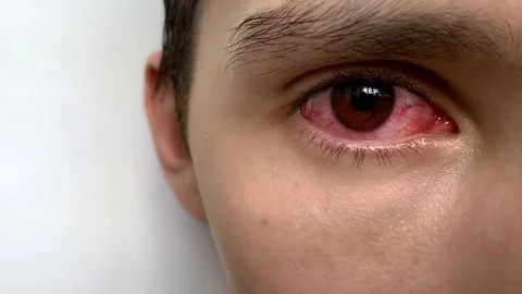 Conjunctivitis red eye. Close up of an irritated red bloodshot eye.  Stock Footage 112020945