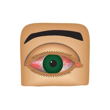 Conjunctivitis. Redness and inflammation of the eye. Vessels in the eye Stock Illustration