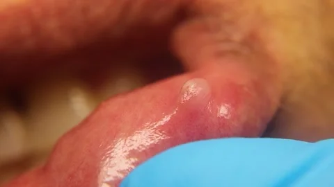 Connective tissue, Lip Scar Tissue from Excessive Wound Healing Medical Macro. Stock Footage 323634214