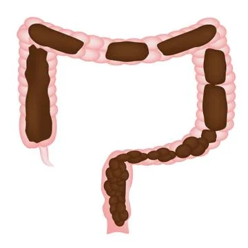 Constipation. Feces in colon. Infographics. Vector illustration on isolated Stock Illustration