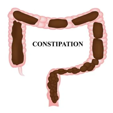Constipation. Feces in colon. Infographics. Vector illustration on isolated Stock Illustration
