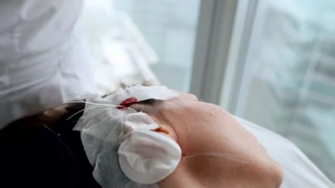 Contemporary facelift by strings, surgeon is inputting string under skin of Video stock 193690864