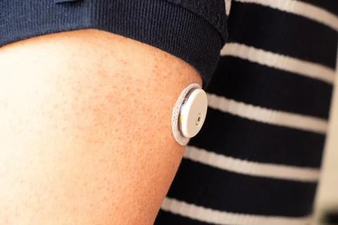 A continuous glucose monitoring sensor is attached to the skin of a man with  Stock Photos