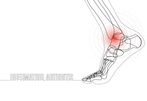Continuous line drawing concept banner about Rheumatoid arthritis Stock Illustration