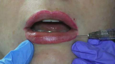 Contour Plastic Lips Stock Footage 65990163