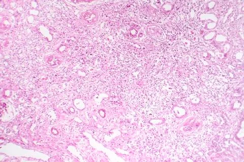 Contracted kidney, light micrograph Stock Photos