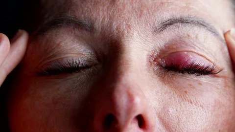 The contrast of light and shadow highlights inflamed eyelids, dry and red eyes  Stock Footage 302172895