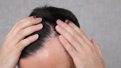 Control hair loss Stockbeeldmateriaal 265090450