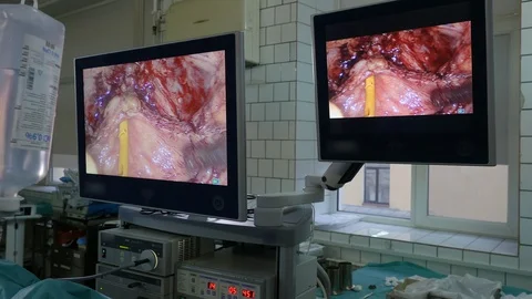 Control screens during laparoscopic surgery Video stock 127768355