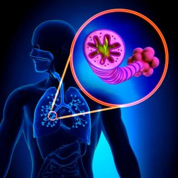 COPD - Chronic obstructive pulmonary disease Stock-Illustration