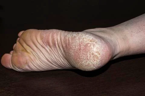 Corn callus cracks on a sole heel foot close up. Dry skin dermatology problem Stock Photos