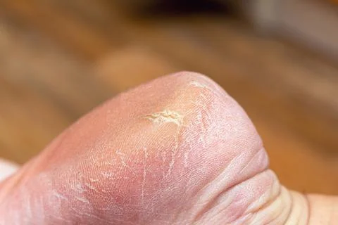 Corn callus cracks on a sole heel foot close up. Dry skin dermatology problem Stock Photos