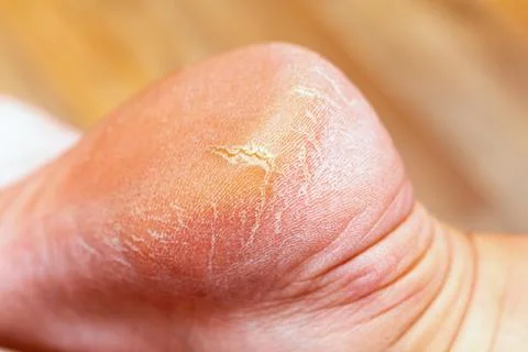 Corn callus cracks on a sole heel foot close up. Dry skin dermatology problem Stock Photos
