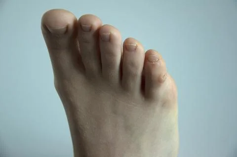 Corn callus on the little toe of a foot. Isolated against a white background. Stock Photos