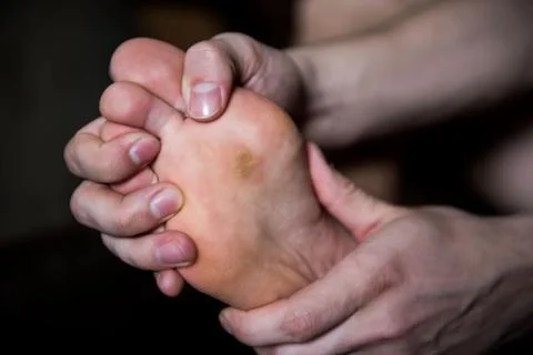Corn on man foot close up on Stock Photos
