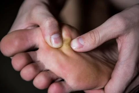Corn on man foot close up on Stock Photos