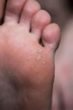 Corn on man foot close up on Stock Photos