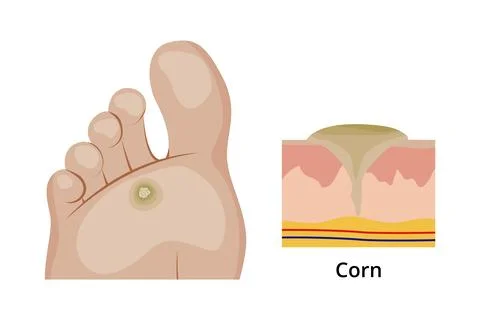 Corn on the sole of the foot and its anatomical structure Stock Illustration