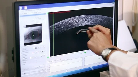 Corneal wavefront analysis Stock Footage 100124261