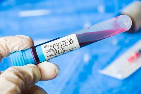 Corona virus positive test samples. Diagnosis and laboratory. Studio shoot, w Stock Photos