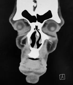 Coronal CT Scan of the Sinuses and Face Stock Photos