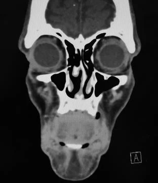 Coronal CT Scan of the Sinuses and Face Stock Photos