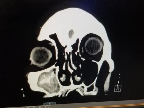 Coronal CT Scan of the Sinuses and Face - Right Maxillary Sinusitis Stock Photos