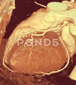 Photograph: Coronary 3d scan 3D CT scan of normal coronary artery ...