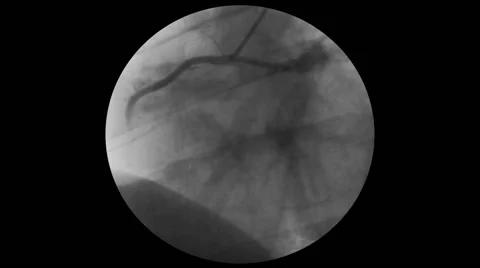 Coronary Angiogram, Blockage Stock Footage 64822892