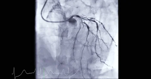 Coronary angiogram in cardiac catheteriz... | Stock Video | Pond5