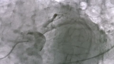 Coronary angiogram Stock Footage 10687715
