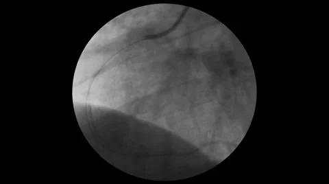 Coronary Angiogram, Stent Stock Footage 64822899