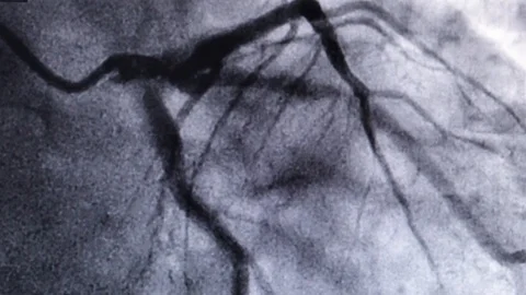 Coronary artery angiogram of left coronary artery during cardiac catheterization Stock Footage
