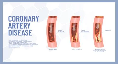Coronary artery pathology, vector of 3 stages of atherosclerosis of heart a.. Stock Illustration