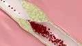 Coronary atherosclerosis disease HD Footage