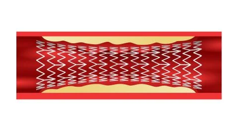 Coronary stent in vessel to keep the passageway Stock Illustration