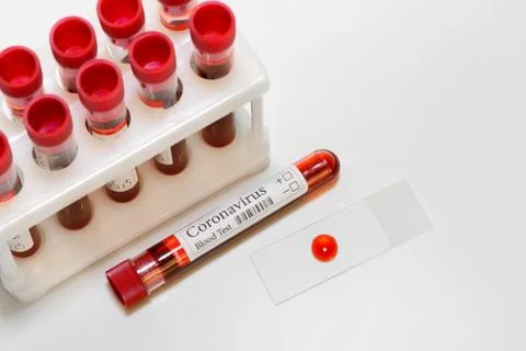 Coronavirus test and laboratory sample of blood isolated Stock Photos