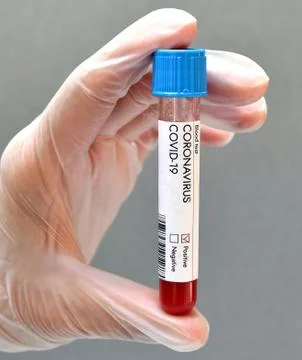 Coronavirus test positive result blood sample Stock Photos