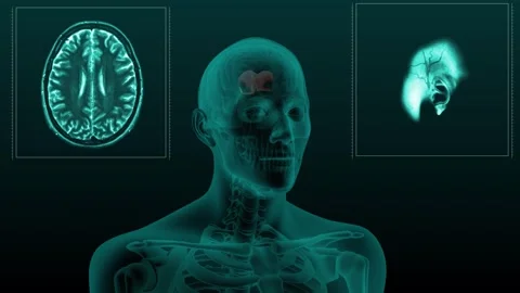 Corpus Callosum Brain MRI Video stock 253545682