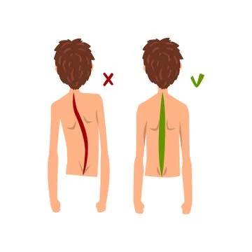 Correct and wrong spine posture, back view vector Illustration on a white 스톡 일러스트