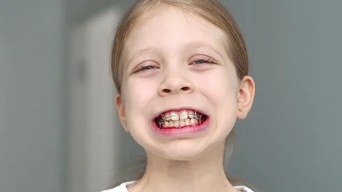 Correcting a girl's bite using a removable orthodontic appliance. A child smiles Stock Footage 256916546