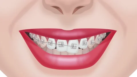 Correction of occlusion with braces Stock Footage 151020614