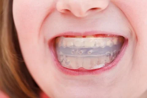 Correction of occlusion by orthodontic trainer Foto stock